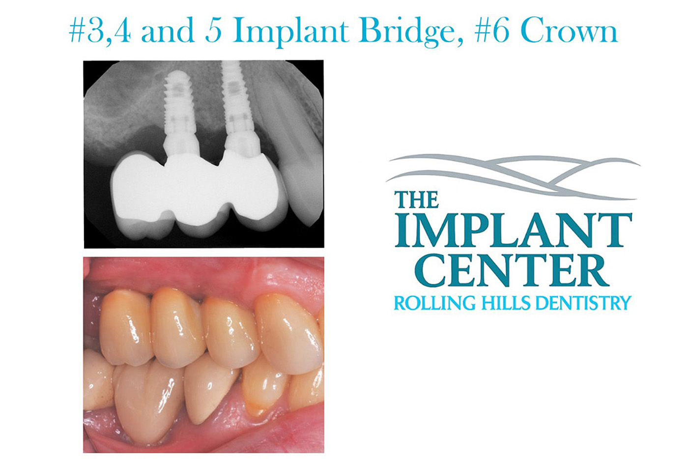 The Implant Center Rolling Hills Dentistry