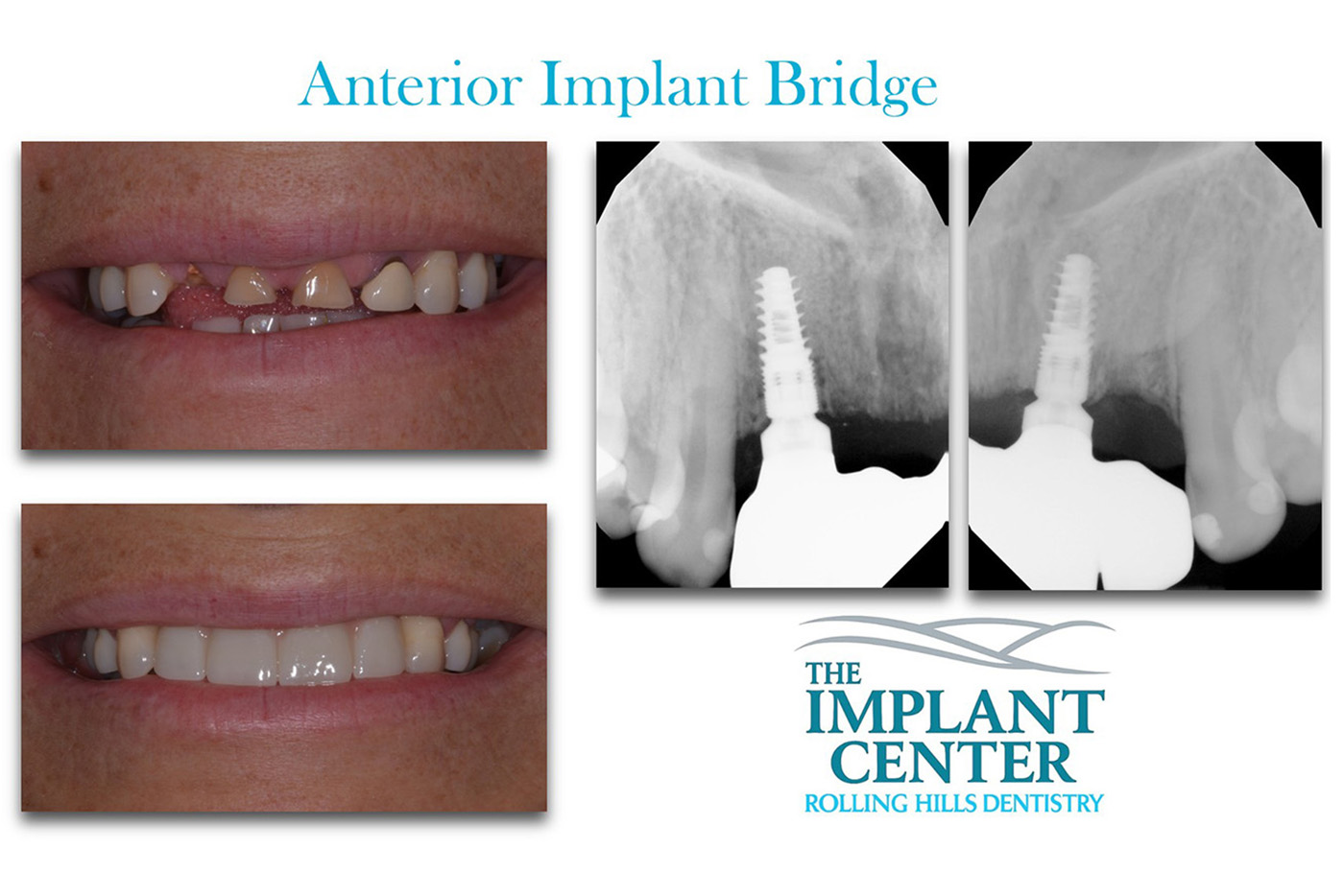 The Implant Center Rolling Hills Dentistry