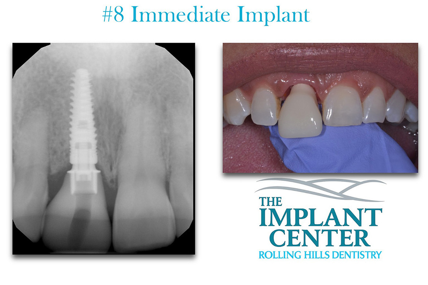 The Implant Center Rolling Hills Dentistry