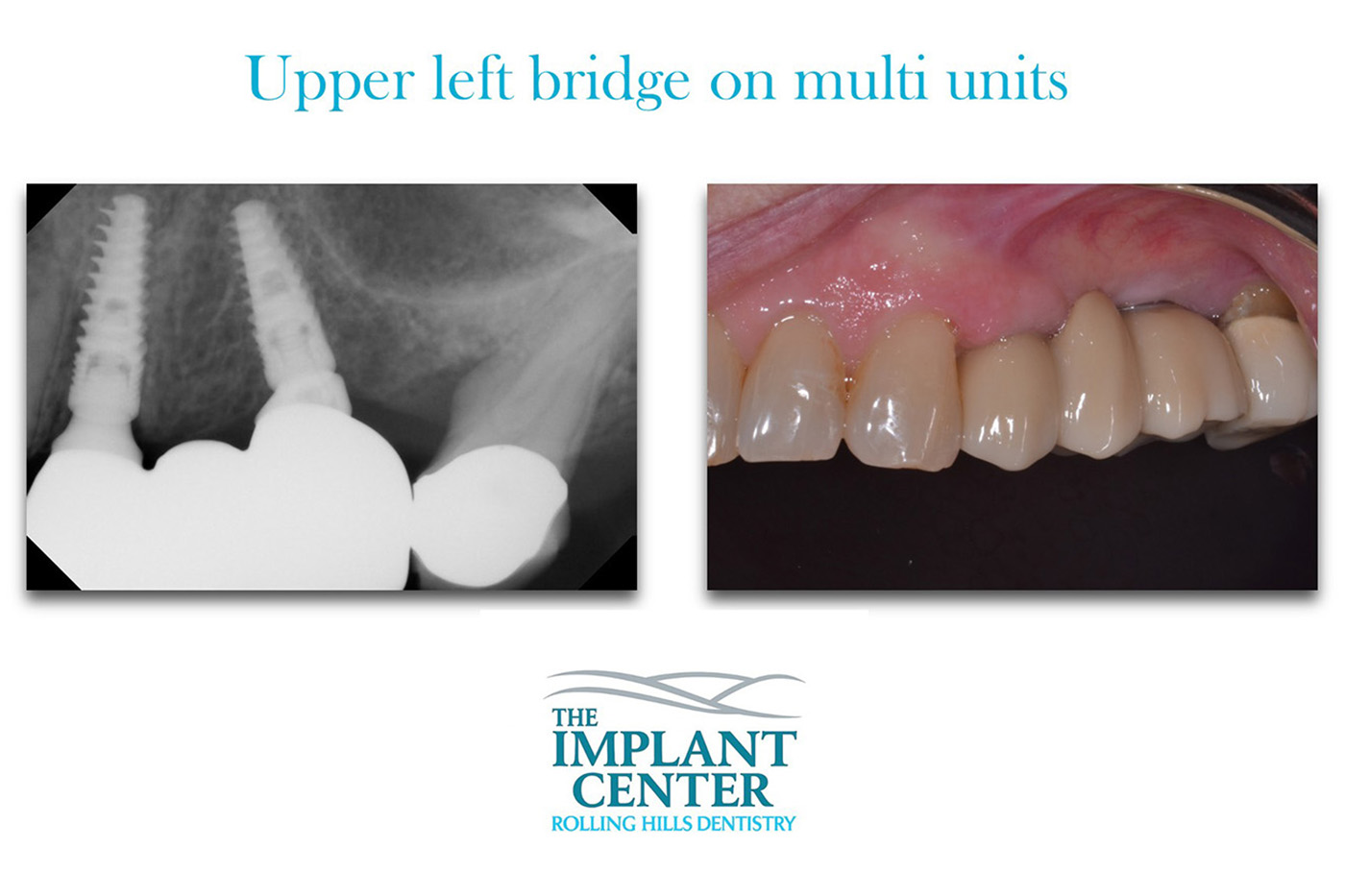 The Implant Center Rolling Hills Dentistry