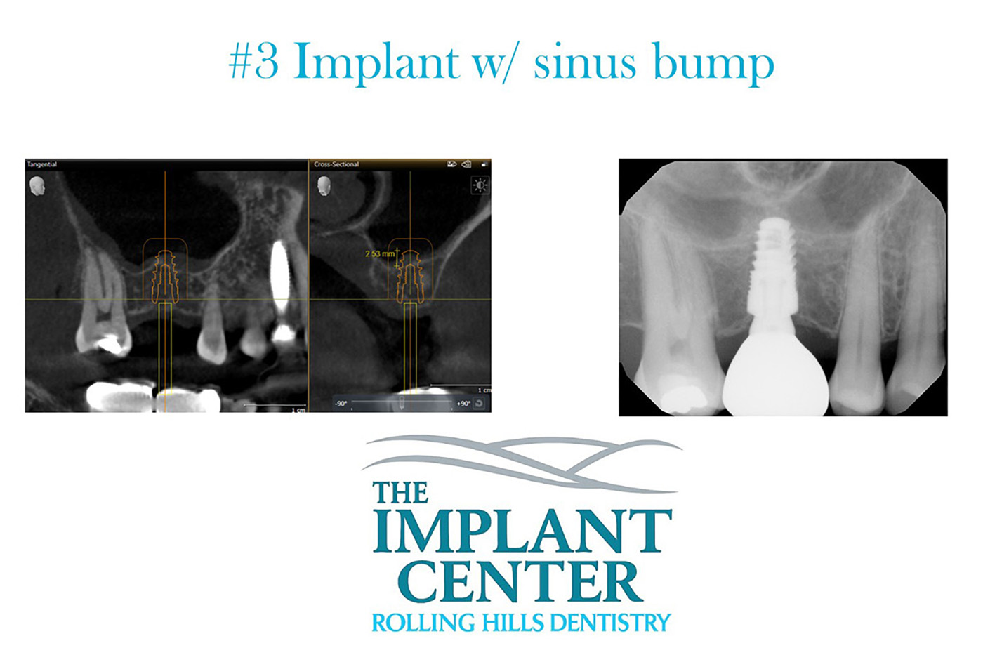 The Implant Center Rolling Hills Dentistry